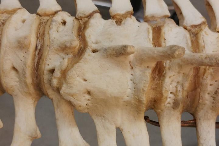 gefuseerde ruggenwervels